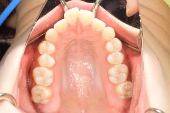 症例1 上顎前突と上下の咬合矯正