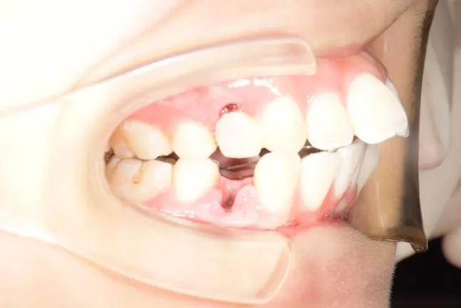 症例1 上顎前突と上下の咬合矯正