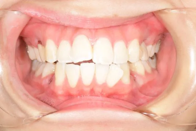 症例1 上顎前突と上下の咬合矯正