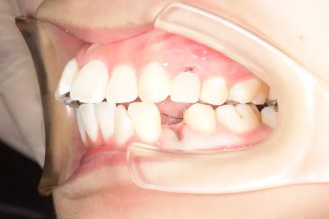 症例1 上顎前突と上下の咬合矯正