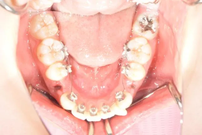 症例1 上顎前突と上下の咬合矯正