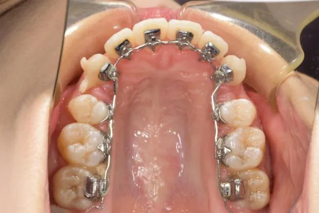 症例1 上顎前突と上下の咬合矯正