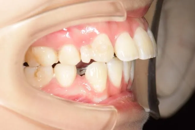 症例1 上顎前突と上下の咬合矯正