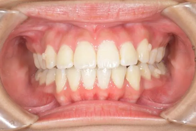 症例1 上顎前突と上下の咬合矯正