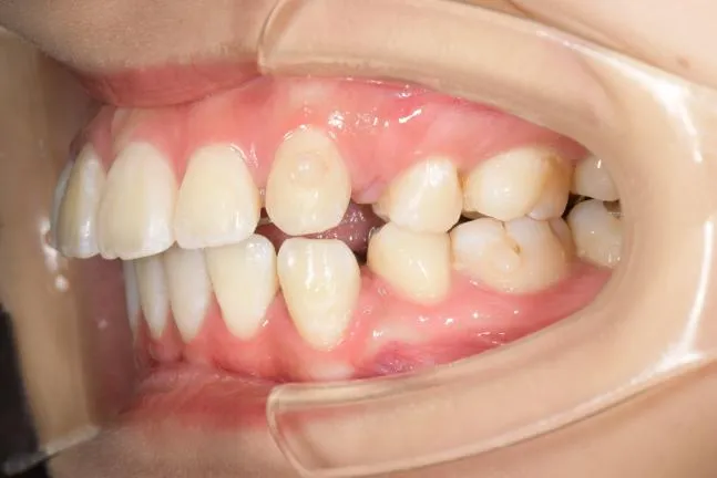 症例1 上顎前突と上下の咬合矯正