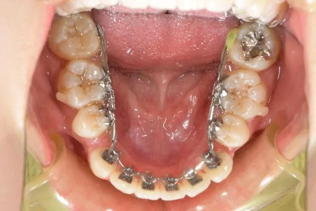 症例1 上顎前突と上下の咬合矯正