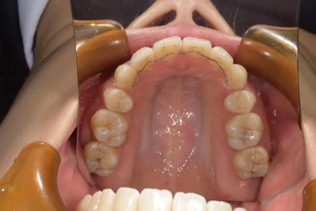 症例1 上顎前突と上下の咬合矯正