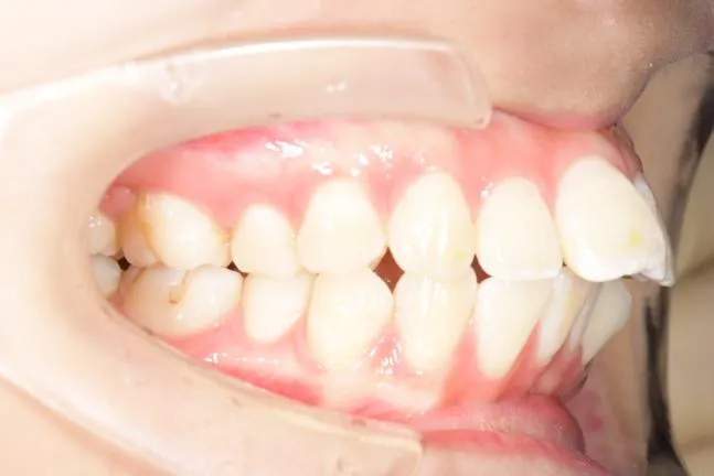 症例1 上顎前突と上下の咬合矯正