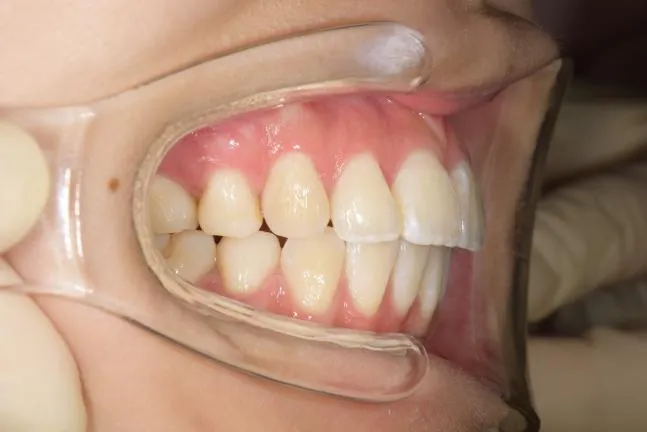 症例1 上顎前突と上下の咬合矯正