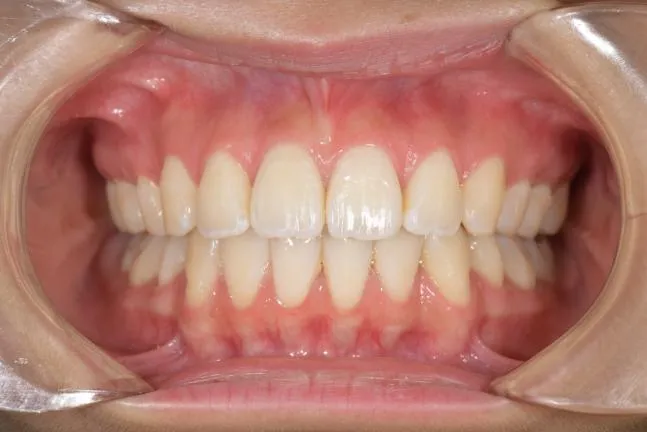 症例1 上顎前突と上下の咬合矯正