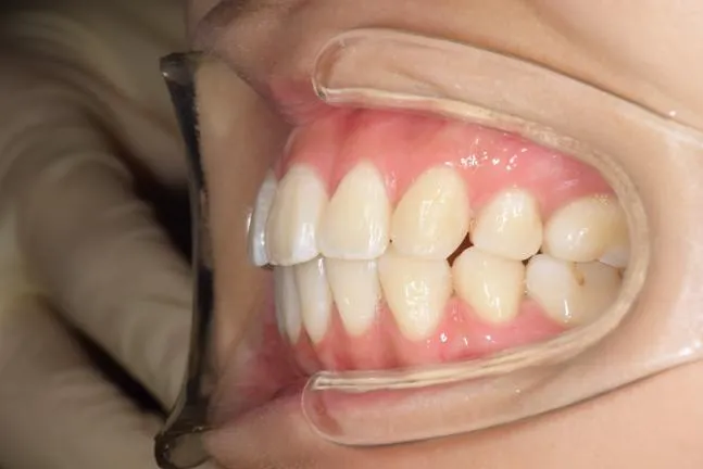 症例1 上顎前突と上下の咬合矯正