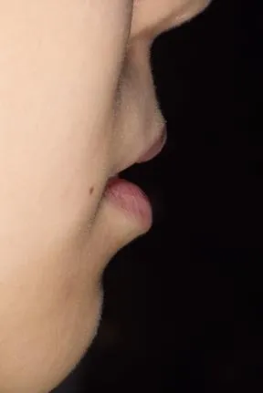 症例1 上顎前突と上下の咬合矯正