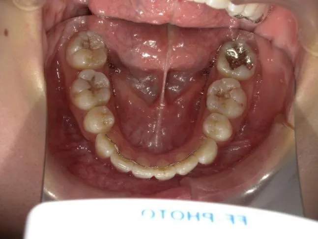 症例1 上顎前突と上下の咬合矯正
