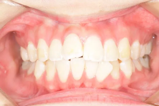 症例1 上顎前突と上下の咬合矯正