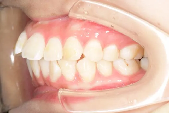 症例1 上顎前突と上下の咬合矯正