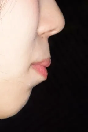 症例1 上顎前突と上下の咬合矯正