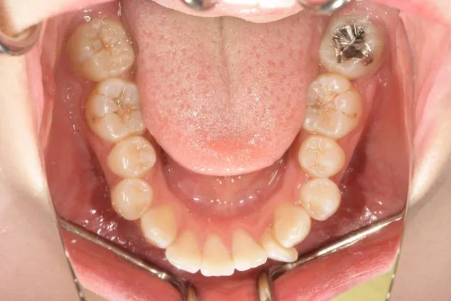 症例1 上顎前突と上下の咬合矯正