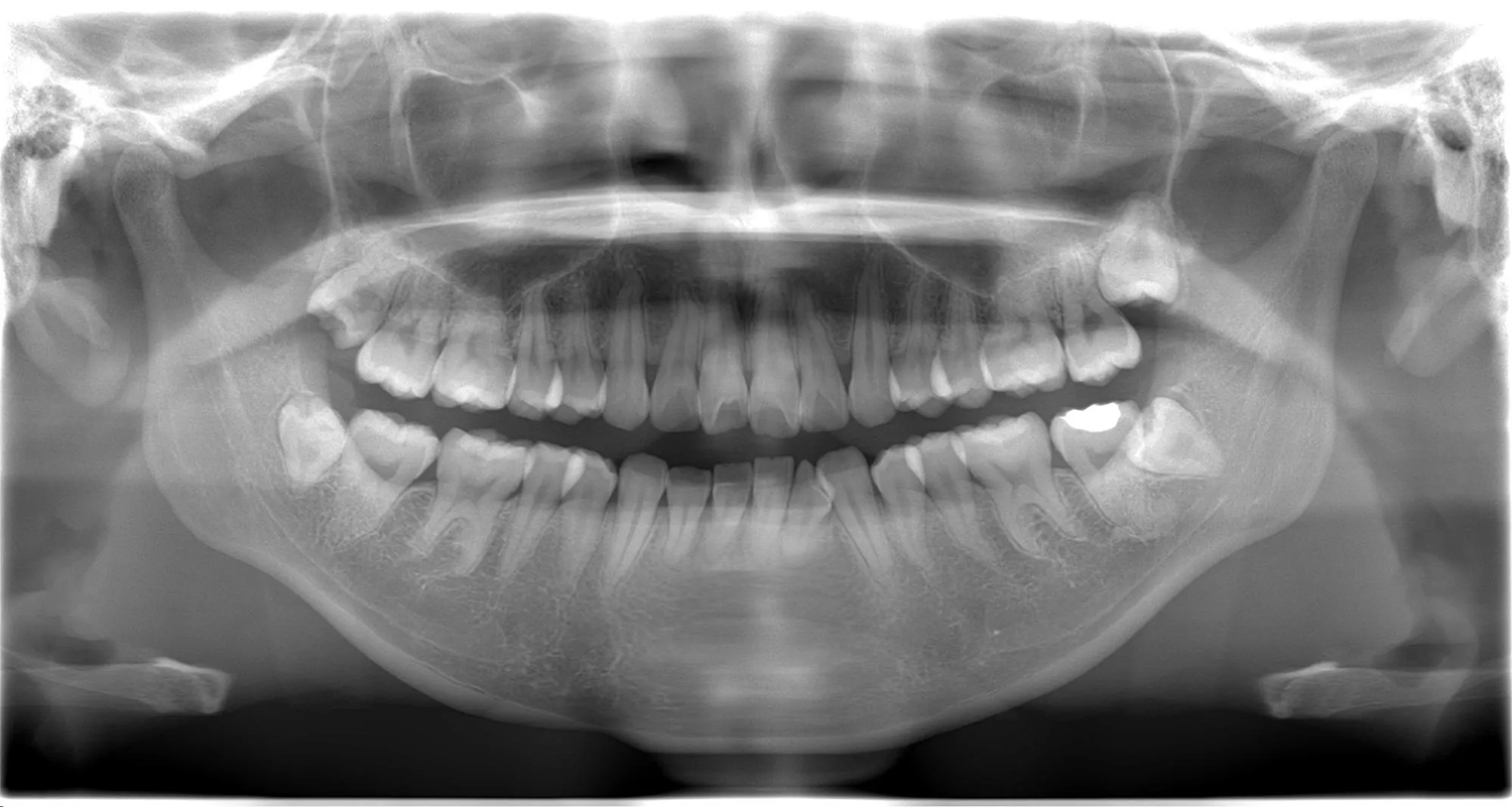 症例1 上顎前突と上下の咬合矯正