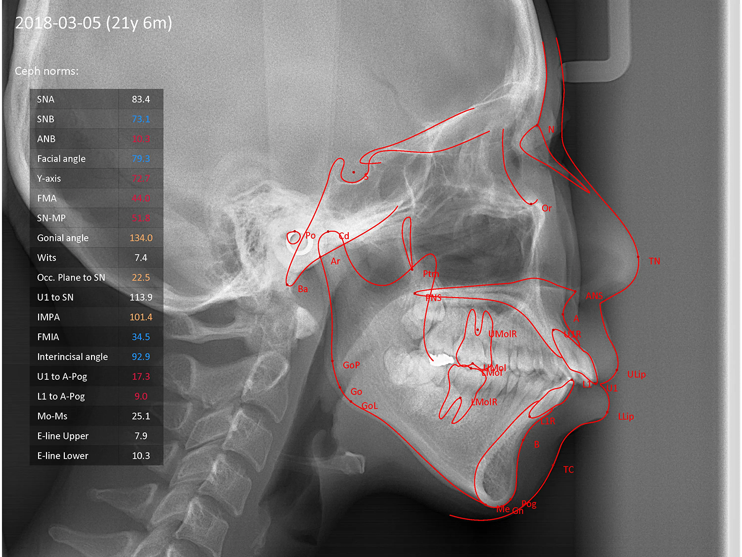 症例1 上顎前突と上下の咬合矯正