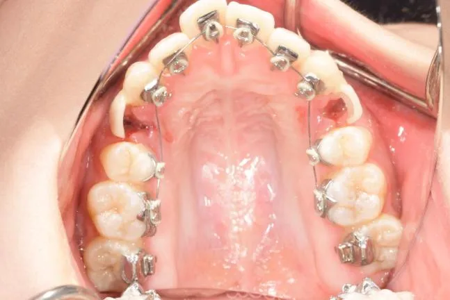 症例1 上顎前突と上下の咬合矯正