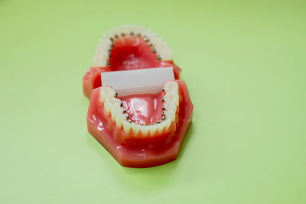 フルリンガル(上下裏側矯正)