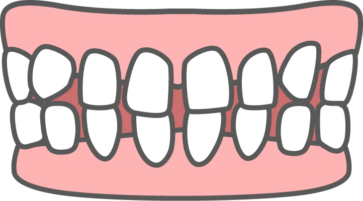 すきっ歯（空隙歯列）
